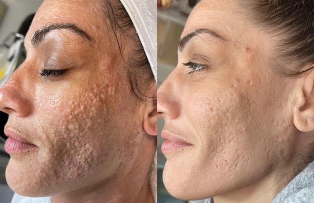 Adult Acne Online Course