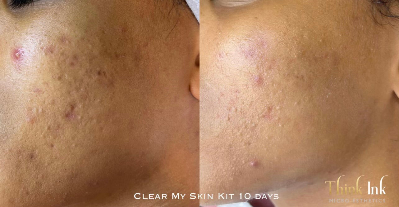 Clear My Skin Kit